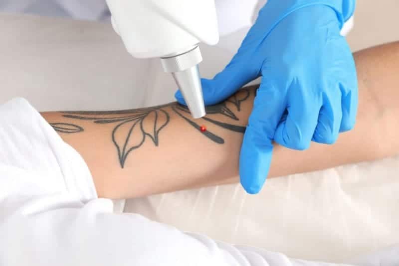 Tecnología para quitarse el tatuaje scaled
